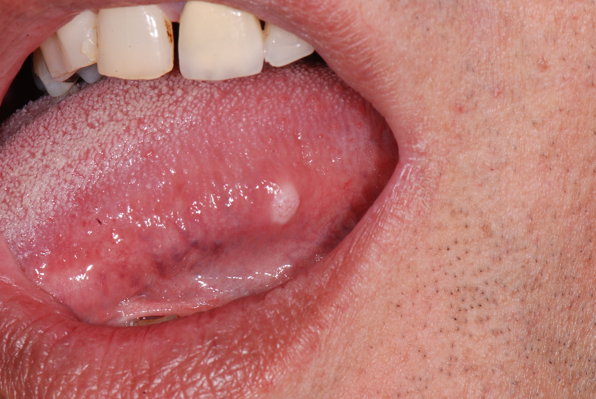 Tongue Cancers